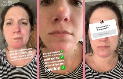 rash on a woman's face