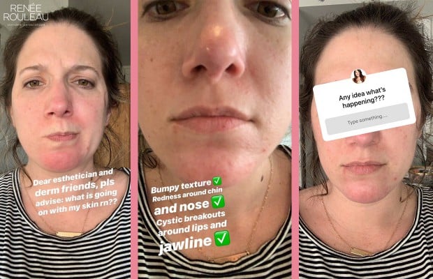rash on a woman's face