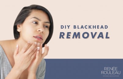 A woman removing a blackhead from her chin