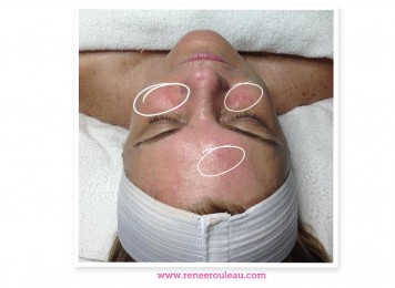 a woman's face with rosacea