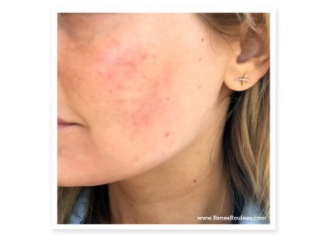acne on a womans face