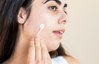 a woman applying acne cream on her cheek