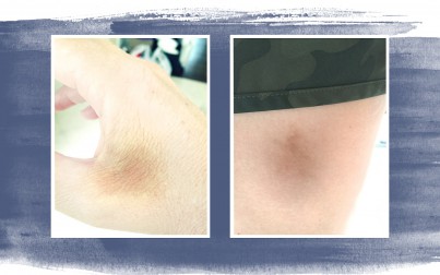 skin discolorations