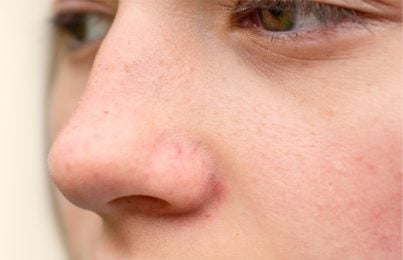 broken blood vessels on a womans nose