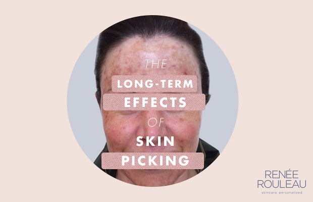a woman with damaged skin by picking at it