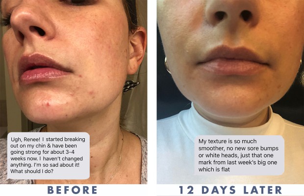 a womans chin before and after acne