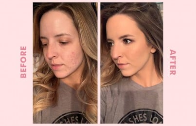 a woman covering up acne with makeup