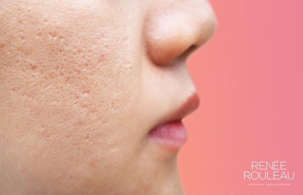 woman's cheek with acne scars