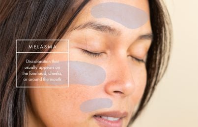 a woman with Melasma on her face
