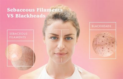 Woman with oily t zone blackheads and sebaceous filaments