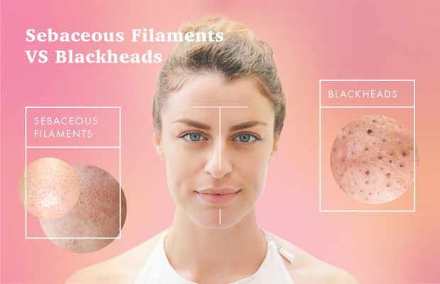 Woman with oily t zone blackheads and sebaceous filaments
