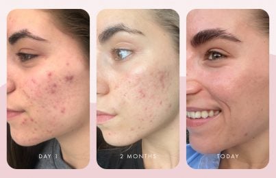 shows the results of pricilla skin care routine to battle acne
