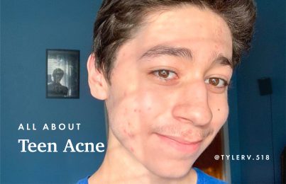 Young teenager with acne smiling