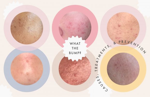 Examples of skin with clogged pores