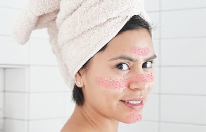 young woman showing facial redness and rosacea