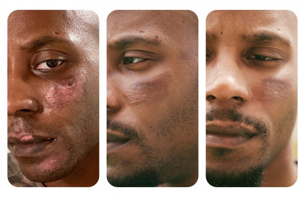 progression of scar tissue healing on a man's cheek