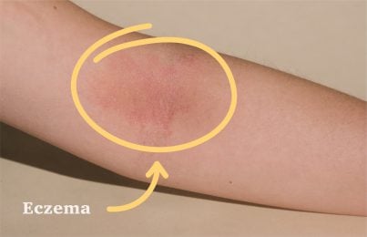 an arm is seen displaying a condition of eczema