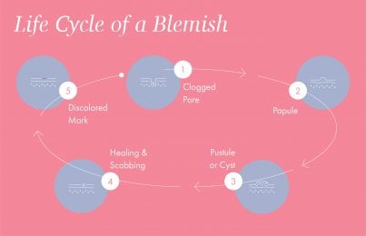 the life cycle of a blemish