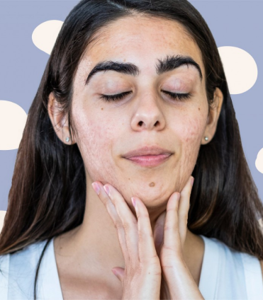 top-category-acne