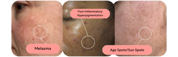 skin with different types of pigmentation
